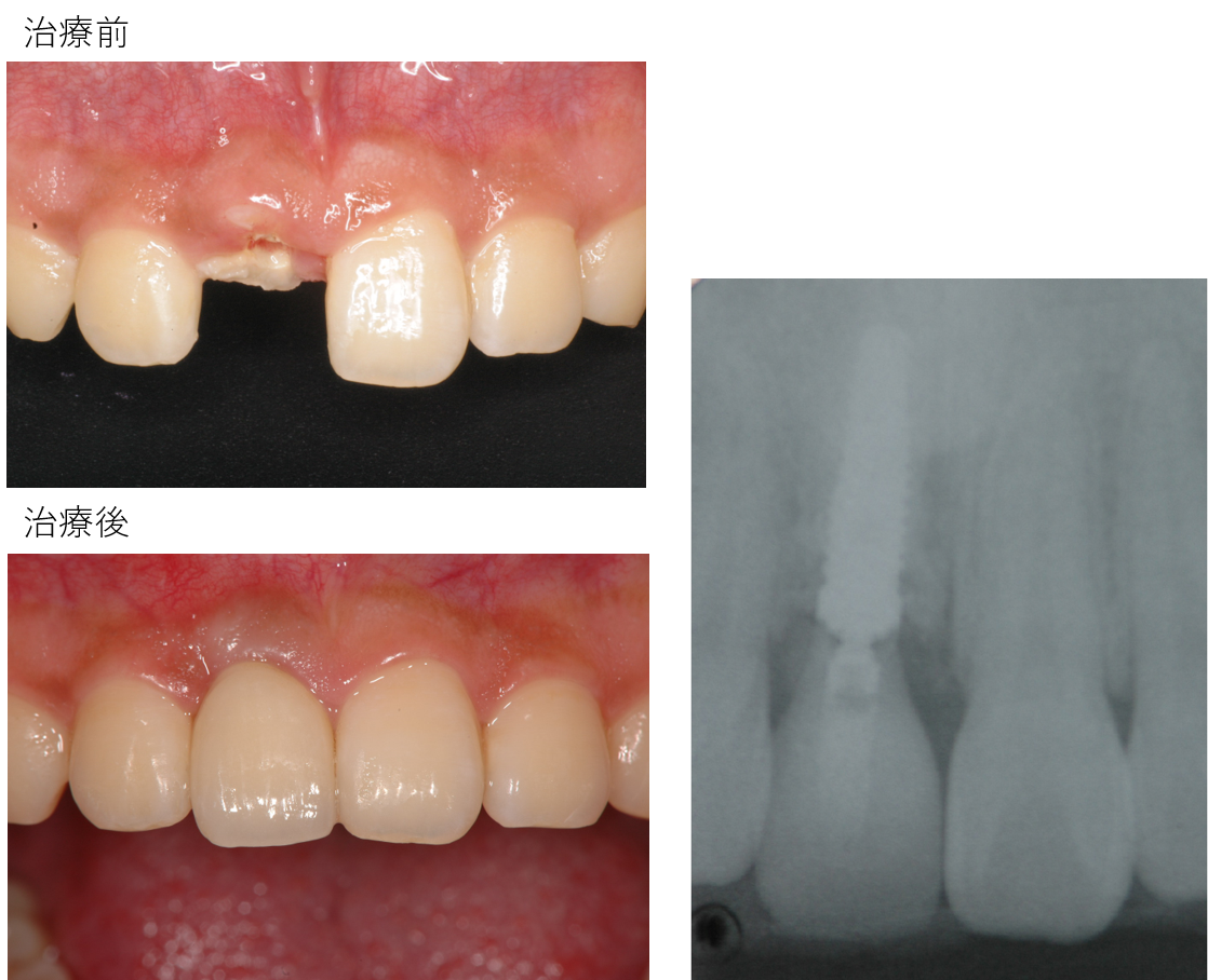 インプラント1