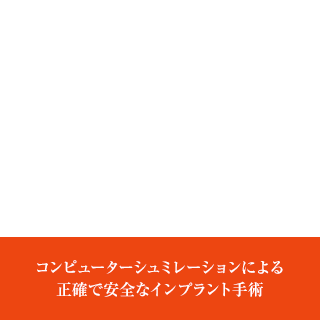 ガイドインプラント