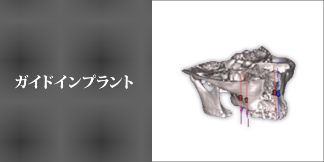 ガイドインプラント