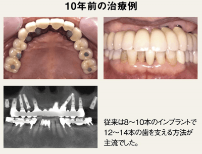無歯顎への対応