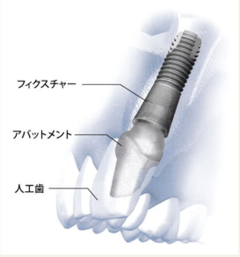 スタンダードインプラントのメリットと特徴