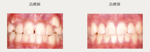 矯正症例