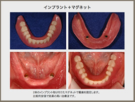 インプラント+マグネット