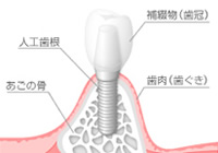 自然で美しい歯を手に入れる