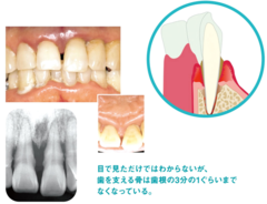 歯がなくなる原因は、「歯周病」と「むし歯」